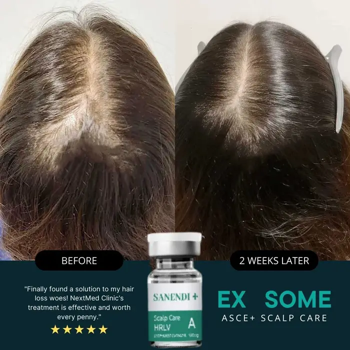 Exobio Meso sérum pour une croissance rapide des cheveux Anti perte de cheveux Kit ASCE + SCALP CARE